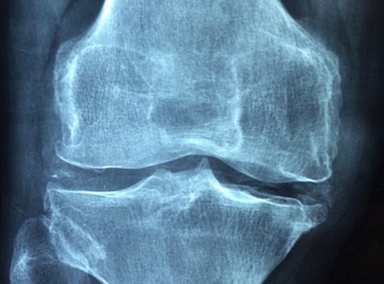 Arthrose genou